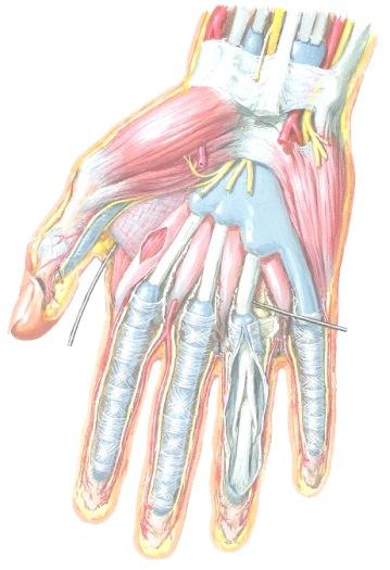 radialis N. medianus M. flexor digitorum profundus Nervus ulnaris arteria ulnaris M. flexor carpi ulnaris, tendo N. ulnaris, syvä haara Katkaistujen lihasten alta paljastuu m.