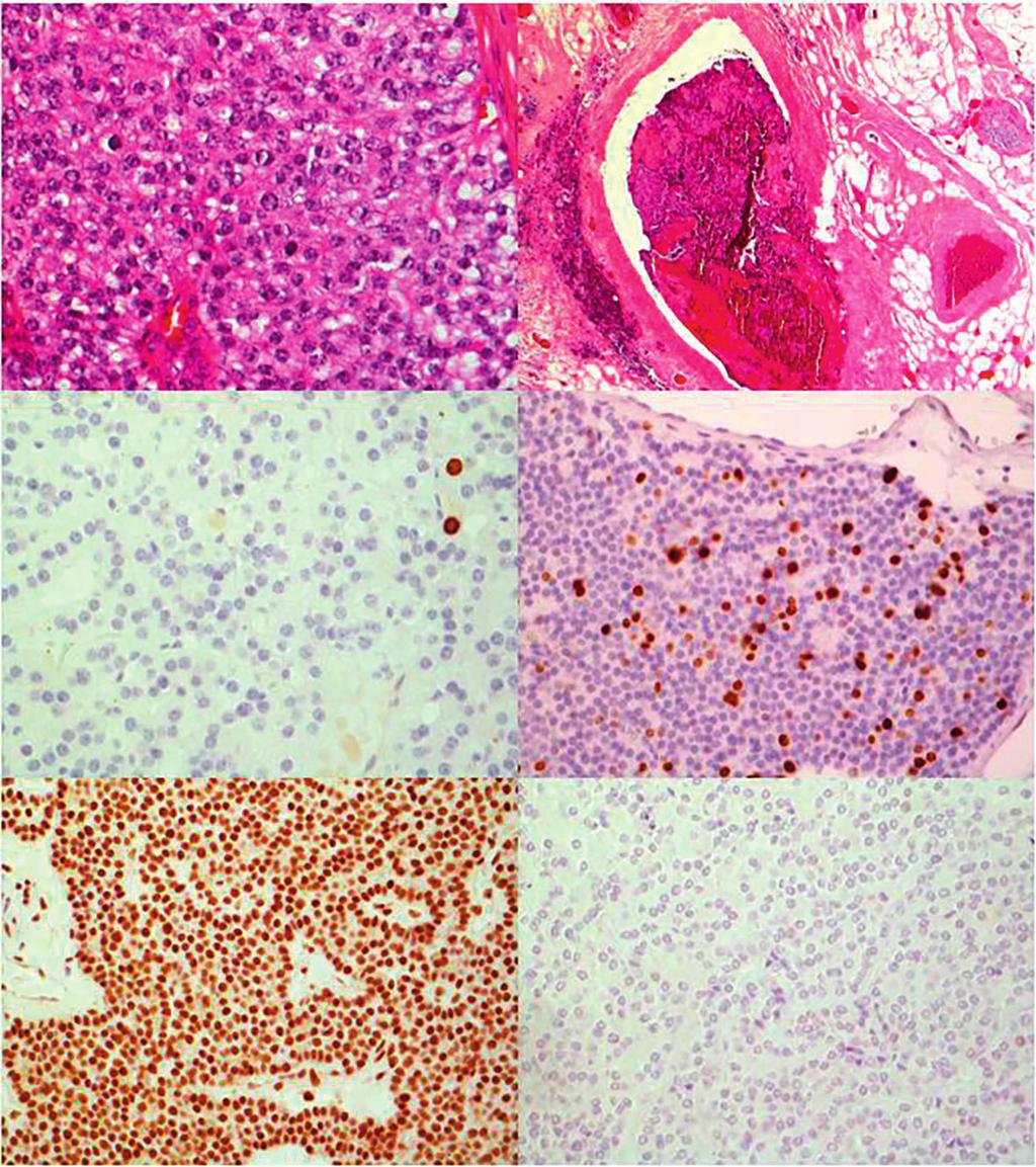A B C D E F KUVA. Histologisia ja immunohistokemiallisia löydöksiä lisäkilpirauhassyövässä. A) Diffuusi kasvutapa lisäkilpirauhassyöpäkudoksessa. B) Lisäkilpirauhassyövän verisuoni-invaasio.