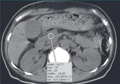 Lihavuusleikkaus ja haiman rasva-aineenvaihdunta C. Insuliini post pre (mu L -1 ). -3. -2. -1.. 1. T2D remissiossa T2D ei remissiossa r = -.761 P =.17-4. -8. -12. -16. A. 5 B.