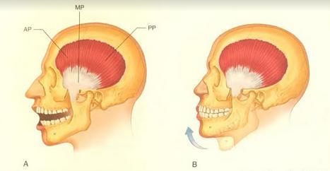 5 Temporalis eli ohimolihas on suuri viuhkamainen lihas. Se lähtee kallon sivulta ohimoseudusta laajalta alueelta ja kiinnittyy alaleuan processus coronoideukseen joka puolestaan jää poskikaaren alle.