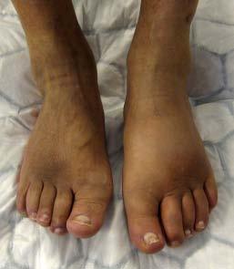 005 31 Peters EJ, Lipsky BA, Aragón- Sánchez J ym, International Working Group on the Diabetic Foot. Interventions in the management of infection in the foot in diabetes: a systematic review.