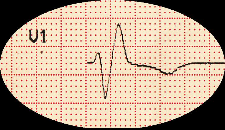 QRS-kompleksin nimeäminen