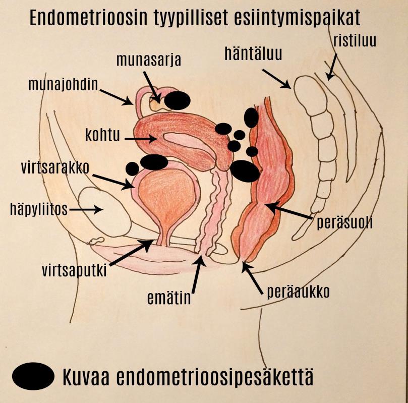 2 2 ENDOMETRIOOSI 2.