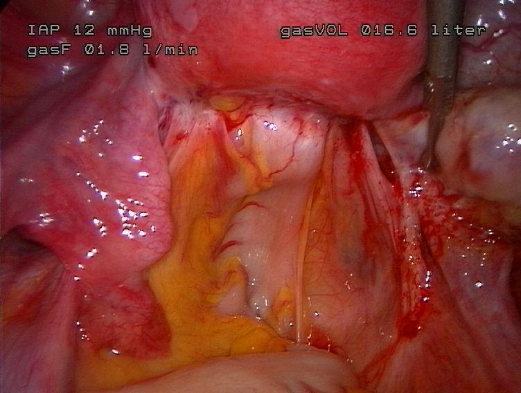 ENDOMETRIOOSI ON YLEINEN SAIRAUS 6-10 %:lla fertiili-ikäisistä (Giudice 2010) Estrogeeniriippuvainen (Bulun 2009)