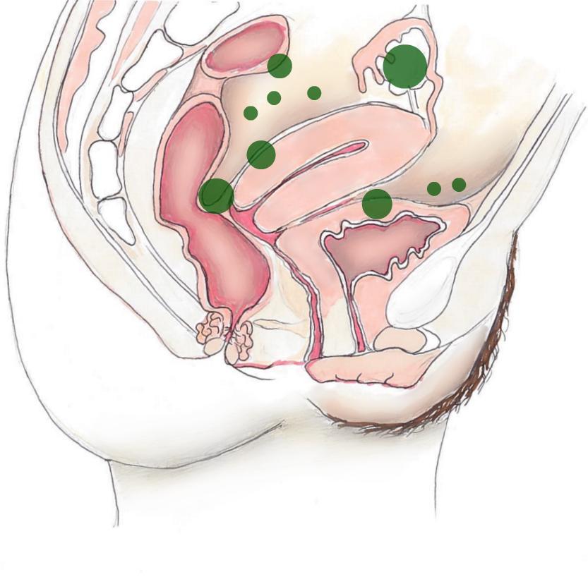 ENDOMETRIOOSIOIREET RIIPPUVAT TAUDIN SIJAINNISTA Vatsakivut