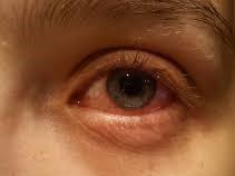 Tulehdukset Silmän etu- ja ulkoisten osien tulehdukset ovat yleisiä, ohimeneviä ja helposti hoidettavia silmään liittyviä sairauksia.
