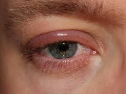 Piilolinssien käyttö on lopetettava eikä silmiä tulisi hangata. Käytössä ollut ripsiväri tulee heittää roskiin, vaikka vain toinen silmä olisi tulehtunut.