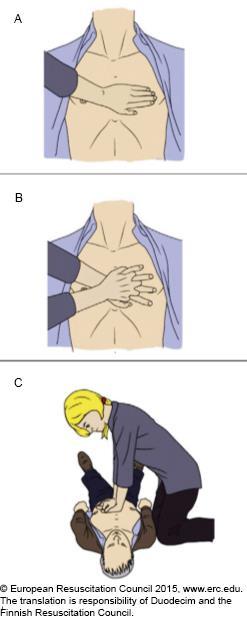 Kuva 1. Oikea paineluasento ja -paikka aikuisella (Käypä hoito suositus 2016) Painelu suoritetaan kädet suorina, hartiat kohtisuoraan elvytettävän rintakehän yläpuolella.