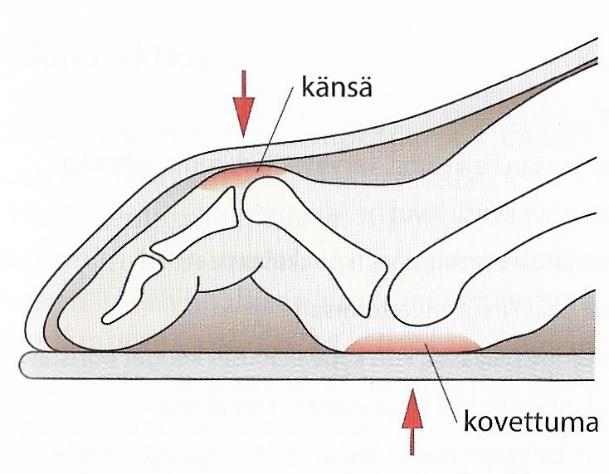 41 Vasaravarpaiden syntyyn vaikuttavat lisäksi myös jalkaterän muiden lihasten toiminta, perintötekijät, vammat, niveltulehdukset ja eräät sairaudet. (Stolt ym. 2017, 304-306.) Kuva 34.