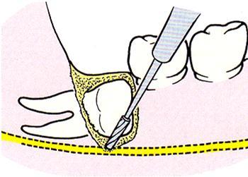 Pieni pala hampaan mukana ei haittaa Murtumalinja alveolikuopassa paina paikoilleen, ompele ja tarv. antibiootti Terävät luusärmät tasoitettava 31 32 Tuber-murtuman hoito 7.