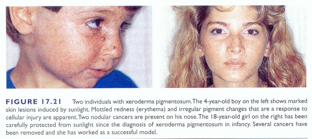 Nucleotide excision repair (NER) systeemin virhe