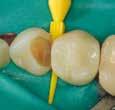 Kalsiumin vapautuminen stimuloi hydroksiapatiitin ja sekundäärisen dentiinisillan muodostusta Alhainen ph edistää paranemista ja