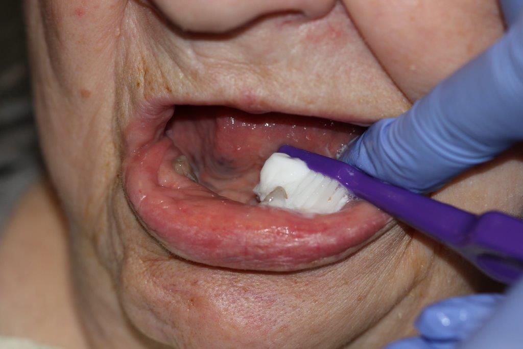 Jos potilas ei itse kykene huolehtimaan suuhygieniastaan, läheisten tai hoitohenkilöstön on päivittäin harjattava hänen hampaansa