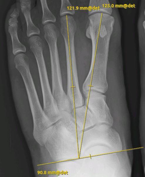 Piirretään kalkaneo-kuboidaalinivelen ja os navicularen mediaalisen kyhmyn välinen viiva. Mitataan etäisyys (M1) toisen metatarsaalin distaalikärjestä tuohon viivaan.