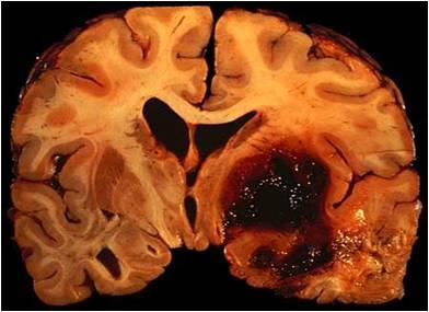 80% Aivoverenvuoto (ICH, intracerebral hemorrhage): vuoto