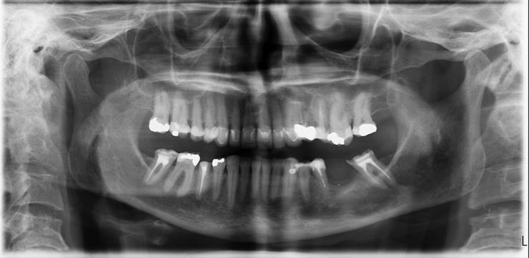 Kuva 13: Panoraamatomografiaröntgenkuva ennen biologista lääkitystä Potilaan proteettinenhoito jatkui syykuussa 2016. D 35 juurihoidosta konsultoitiin endodontian erikoishammaslääkäriä.