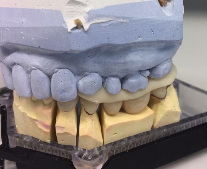 Tämän lisäksi otettiin vielä tarkkuusjäljennös Putty Wash tekniikalla. Kandi suunnitteli täytteen CAD/CAM:in Cerec 4.4 suunnitteluohjelmalla.