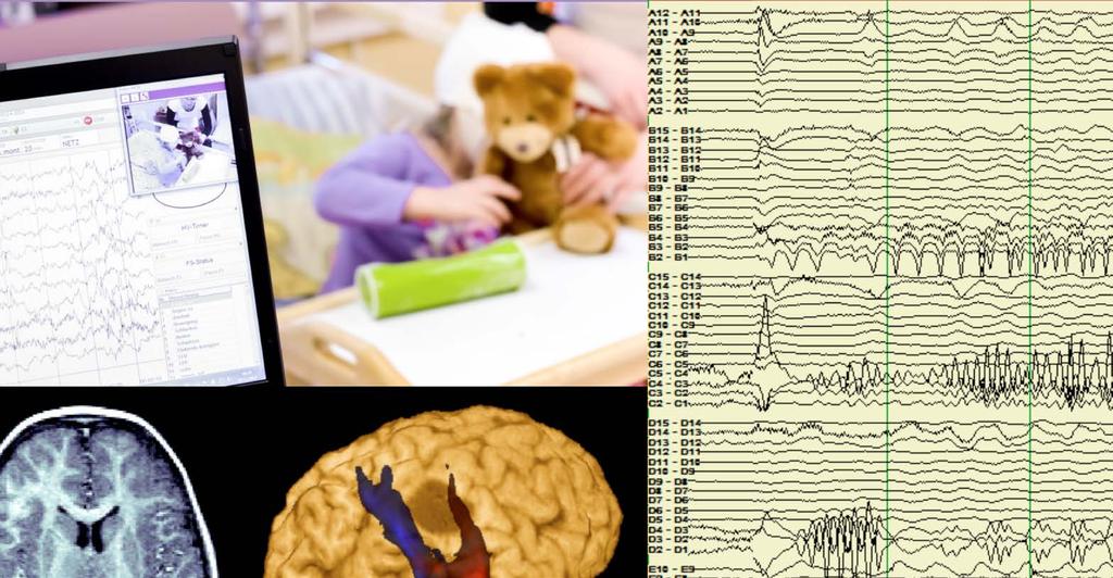 Epilepsioiden eurooppalainen osaamisverkosto (EpiCARE) Epilepsia koskettaa vähintään kuutta miljoonaa ihmistä Euroopassa.