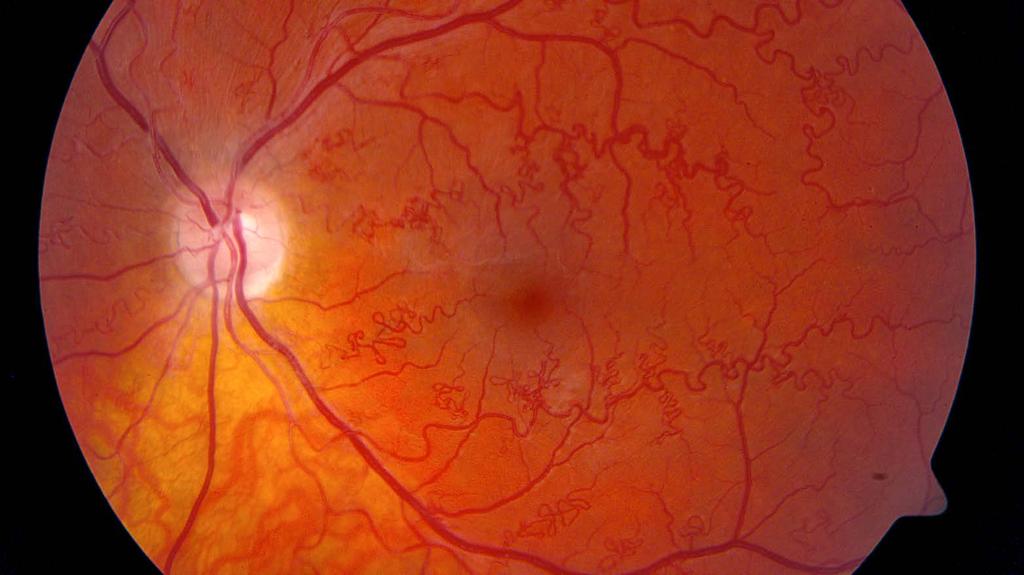 Silmäsairauksien eurooppalainen osaamisverkosto (ERN EYE) 20 Harvinaiset silmäsairaudet (RED) ovat lasten ja nuorten aikuisten näkökyvyn heikkenemisen ja sokeutumisen pääasiallisia aiheuttajia.