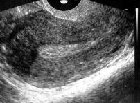 A Kuva 2. Kohdun limakalvo näyttää normaalilta vaginaalisessa kaikukuvauksessa (A), mutta sonohysterografiassa vuotohäiriöiden taustalta paljastuu polyyppi (B).