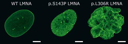 KUVA 4. Mutaatiot LMNA-geenissä häiritsevät lamiinien polymerisaatiota. Vasemmalla normaalin fibroblastin tuma, jossa villin tyypin lamiini A (WT LMNA) muodostaa sileän tumalevyn.
