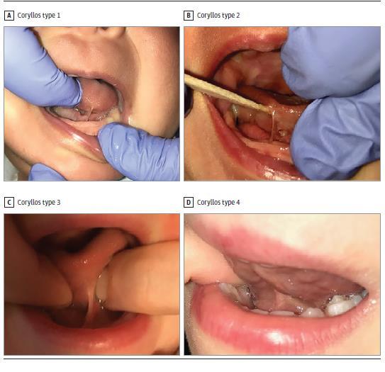 Riittämätön laktogeneesi: lapseen liittyviä tekijöitä Puutteellinen tarttuminen (latch) ja imu: Vaisu / sairas vastasyntynyt lihashypotonia ennenaikaisuus suun alueen anomaliat (halkiot, kielijänne)