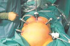Avo- ja alatiekirurgia olivat lähestymistapoja kunnes 1980-luvulla laparoskoopit ilmestyivät leikkaussaleihin.