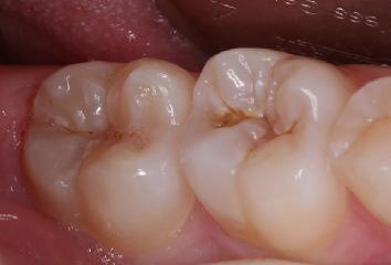 Vaurion pintaa ei ole mahdollista pitää puhtaana esimerkiksi kavitaation vuoksi 2. Vaurio on edennyt dentiiniin puoliväliä pidemmälle, vaikka vaurion pinta olisikin mahdollista pitää puhtaana.