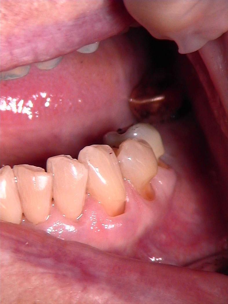 Sidostaminen Sidoslujuuksia tutkittu kliinisesti hampaan kervikaalisissa vaurioissa, jossa ei ole kariesta mekaaninen retentio puuttuu leesioiden koko rajattu ja verrannollinen eri tapauksissa ei