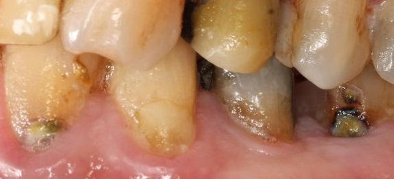 Yhteenveto Oraali- ja fakiaalipinnat (kruunun alue) -Kiille rikki dentiiniin asti (vaikka vain pieneltä alueelta), dentiini voi kuultaa tummana -Rtg:ssa näkyy selkeä kariesleesio dentiinissä