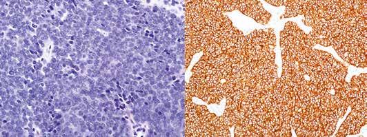 A B KUVA 3. Histologisesti Ewingin sarkooma muodostuu niukkasolulimaisista pyöreätumaisista soluista, jotka eivät muodosta rakenteita.