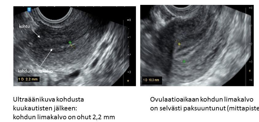 Gynekologinen tutkimus + UÄ Arvioidaan kuukautiskierron