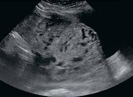 A B C D KUVA 2. A D) Kysymyksessä on 29. raskausviikolla oleva nainen, jolla on taustalla kaksi keisarileikkausta ja jolla nykyraskaudessa istukka sijaitsee etisenä eli kohdunsuun päälle asettuneena.