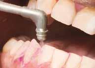 Plakin ja biofilmin poisto onnistuu ahtaasta hampaistosta, hampaiden väleistä, kuopista ja fissuuroista, jotka ovat yleensä puhdistuskuppien tavoittamattomissa.