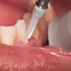 Kapea kärkisuuttimen muovikärki on juuri sopivan joustava liikkuakseen sujuvasti hampaan pinnan yli, ja sen saa helposti ahtaisiin taskuihin ja viereisten hampaiden juurten pinnoille