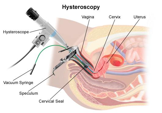 HYSTEROSKOPIA