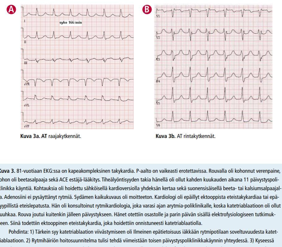 Potilasesimerkki SYKE 166/min Eteistakykardia: Eteisen solukon aiheuttama tykytys, - huono olo, painava tunne rinnassa - johtaa