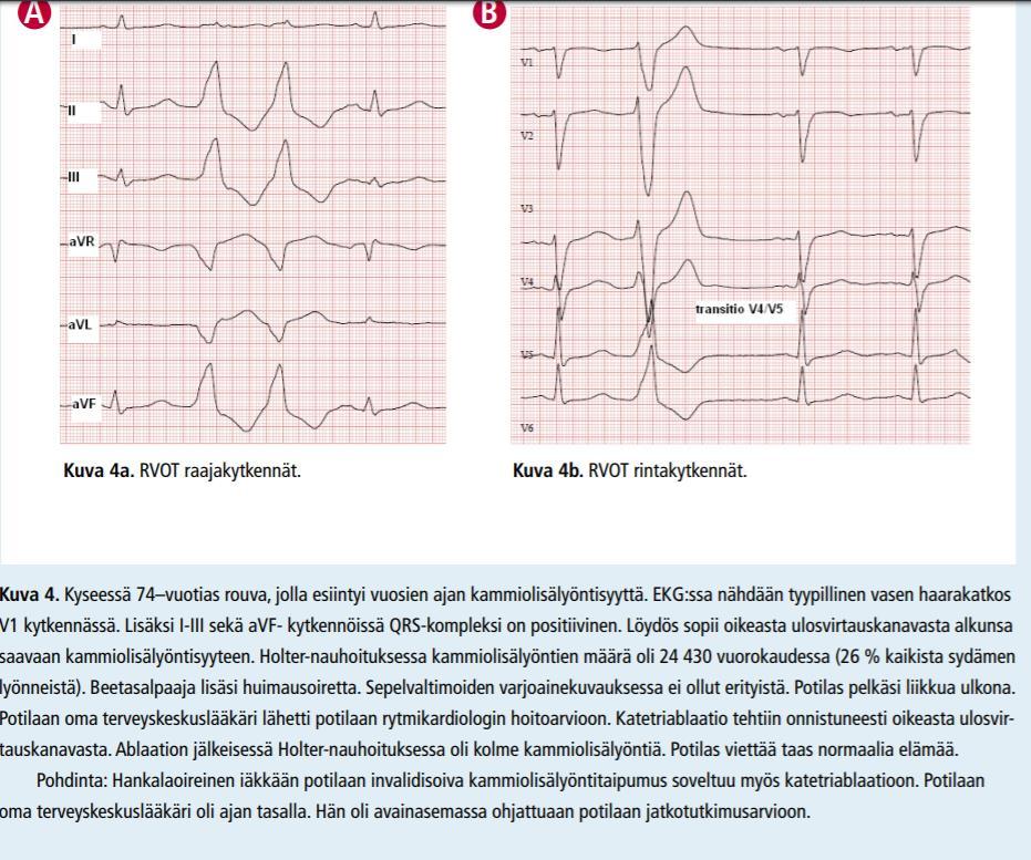Sydämen kammioperäinen lisälyöntisyys Potilasesimerkki Sydänsähkökäyrästä (EKG) voidaan karkeasti arvioida