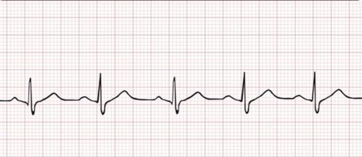 Sydämen johtoratajärjestelmä ohjaa sydämen supistumista ja rytmiä 1. Sinussolmuke: (tahdistajasolmuke) -AUTONOMINEN 2.