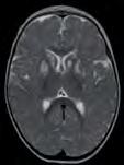Leighin oireyhtymä poikkeava uneliaisuus (letargia) epilepsia lisääntynyt lihasjäykkyys (spastisiteetti) lihasjänteyshäiriö (dystonia) pakkoliikkeet (korea) liikkeiden koordinaation häiriö (ataksia)