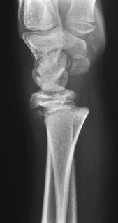 Röntgenkuvaus on edelleen ensisijainen käden ja ranteen kuvantamismenetelmä luuvammaa tai muuta luuta affisoivaa prosessia epäiltäessä.