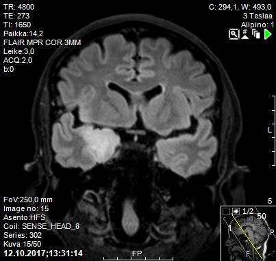 Likvor paljastaa diagnoosin, MRI löydös selvenee Enkefaliittiepäilyn vuoksi aloitettiin keftriaksoni, doksisykliini ja asikloviiri iv.