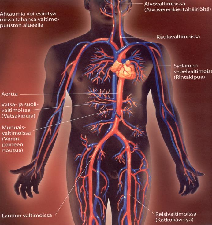 Sydän- ja verisuonisairaudet = Valtimotaudit Verisuoniseinämän monisyinen tulehdus ja valtimoahtaumat Korkea verensokeritaso