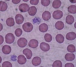 Hoidon tavoitteet Sokerihemoglobiini HbA1c - punasolujen sokeri Sokerihemoglobiini HbA1c Normaali 31 42 mmol/mol (= 4 6 % ) Käypä hoito suositus < 53 mmol/mol (< 7 %) Yleinen tavoite