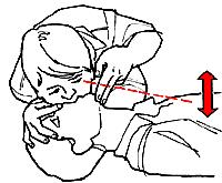 Jos hengitys käynnistyy, käännä potilas kylkiasentoon, jos ei, aloita elvytys. 5. Sulje toisella kädellä sieraimet ja pidä toisella kädellä potilaan leukaa ylhäällä.