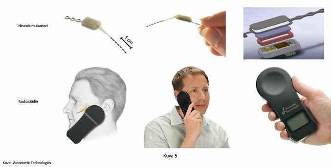 Neurostimulaattori Kaukosäädin KUVA 5. Sfenopalatiiniganglion stimulaattori ja kaukosäädin, jolla se aktivoidaan. Kuva: Autonomic Technologies haittavaikutuksia.