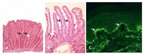 KUVA 2. A) Ravinnon gluteenin aiheuttama keliakiapotilaan ohutsuolen limakalvovaurio: kryptahyperplasia (nuolet) ja nukkalisäkkeiden puuttuminen.