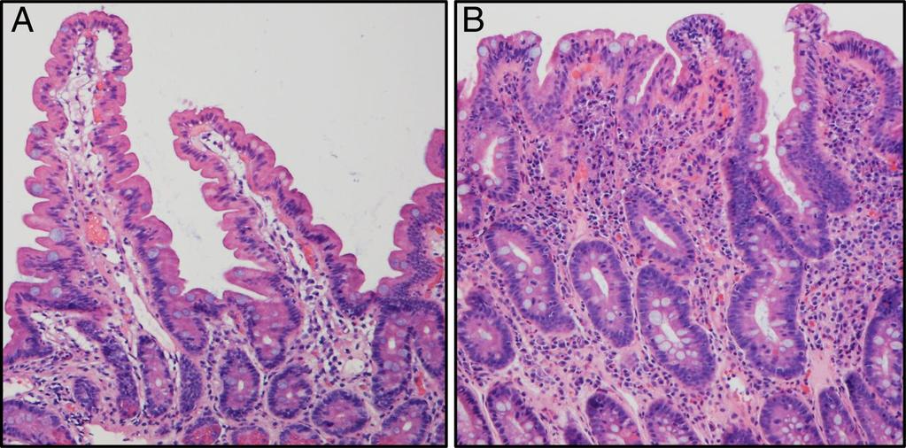 Keliakia Diagnoosi edellyttää histologista varmiststa ennen dieetin aloitsta Villsatrofia Kryptahyperplasia Intraepiteliaalinen lymfosytoosi Voi ilmetä