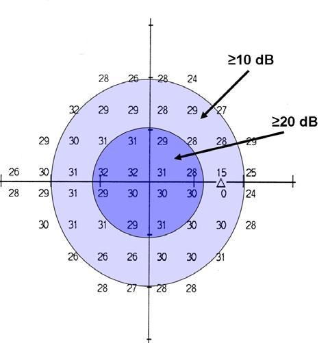 Figur 2. Det centrala synfältet mätt med Humphrey program 24-2.