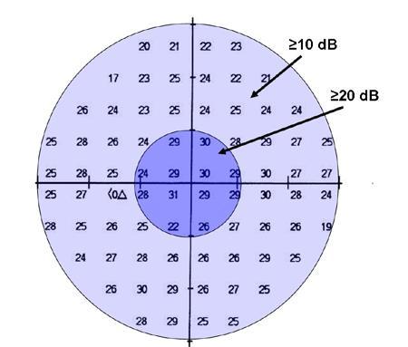 Figur 4. Det centrala synfältet mätt med Humphrey program 30-2.